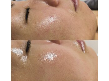 サロン ウルハ(Salon Uruha)/マイクロニードルピーリング