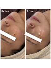 カラット(CARAT)/光フェイシャル×ララピール