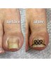 トータルケアコース+巻き爪矯正1本（角質ケアと巻き爪矯正をしたい方に！）