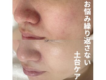 プラセル(Placer)