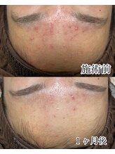 ハル(Halu)/額にきび：施術前～１か月の変化