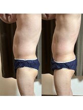 スリール(sourire)/ビフォーアフター　1回