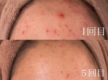 ハリト エステ(HaRi&)の雰囲気(頑固なニキビもハーブピーリング×毛穴洗浄で撃退★)