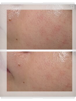 ルミナリー 仙台五橋(luminary)/ソフトダーマ×ハイドロフェイス