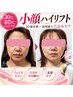 【当店オススメ★】小顔ハイリフト│3D超音波×高周波でたるみケア