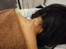 上野毛駅前整骨院 鍼灸院/首こりへの鍼