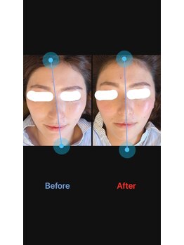 美容矯正サロン レレポノ(LELEPONO)/鼻の歪み矯正・小顔矯正