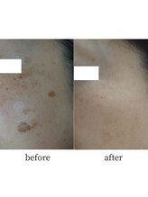 アップルミント/＜フェイシャル＞before・after