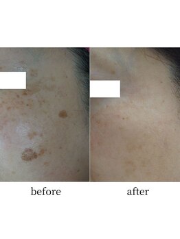 アップルミント/＜フェイシャル＞before・after