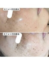 ラエッセ 目黒 白金台店(LAESSE)/毛穴・美白専門店 LAESSE 白金台