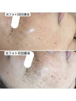 ラエッセ 目黒 白金台店(LAESSE)/毛穴・美白専門店 LAESSE 白金台