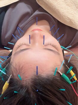 瑞 鍼灸院/頭皮鍼+美容鍼