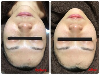 アイリス(AIRIS)/ニキビ、肌荒れにお悩みの方