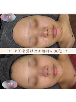 美肌研究所 絹 田辺店/光フェイシャルで肌質改善★