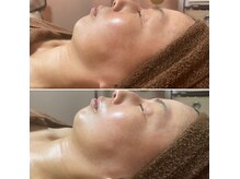 コルッソ(CoLusson.)の雰囲気（ホワイトスノーピール/速攻美白/ハリ/艶肌肌質改善/シミ/シワ）