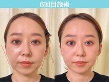 ナチュラルパーフェクトフェイス 新宿/6回目施術