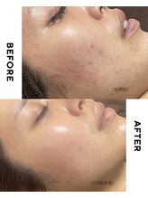 ホソナル(HOSONAL)/マイクロニードルピーリング