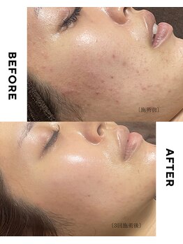 ホソナル(HOSONAL)/マイクロニードルピーリング