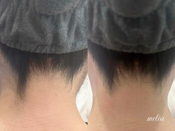 メリア 岡山駅前店(melia)/うなじWAX