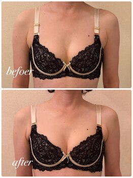 シャルマン(Charmant)/befoer.after