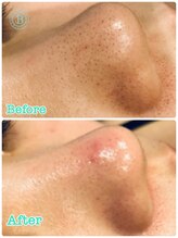 バナナ 福井店(Banana)/毛穴洗浄ビフォーアフター