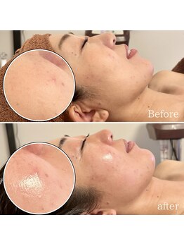 ツルル 岡崎店(TSURURU)/【マイクロニードルピーリング】