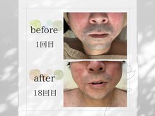 アンフルール(Une fleur)/脱毛 Before&After