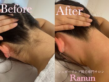 ラナン(Ranun)/1番変化が分かるうなじ脱毛!