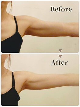 セッテベレッザ(Sette Bellezza)/二の腕はみ肉ケア