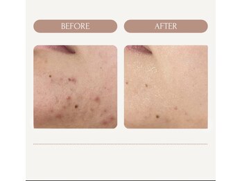 マオ(mao)/☆5回Before→after☆