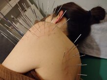 上野毛駅前整骨院 鍼灸院/肩が上がりにくい人への鍼