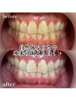 エピリス(Epiliss)/ホワイトニングビフォーアフター