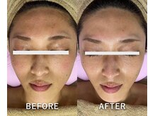 サロンドジェシカ(salon de Jessica)/お顔脱毛 シェービング付 