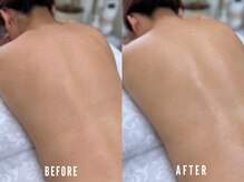 ビーグラム(B.GLAM)/ダブル脱毛／うなじ＋背中