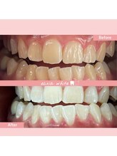 エクシアホワイトニング 札幌琴似店/ホワイトニングビフォーアフター