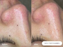 フォンビューティー(fon beauty)/毛穴ケア1回