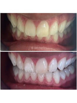 エクシアホワイトニング 代々木店/ホワイトニングビフォーアフター