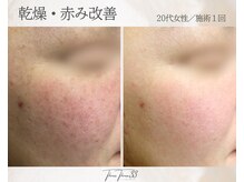 スリースリー 恵比寿(THREE THREE)/乾燥・赤みケア