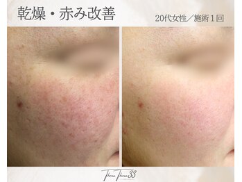 スリースリー 恵比寿(THREE THREE)/乾燥・赤みケア