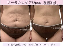 ラエッセ(La Esse)/産後のたるんだお肌も改善？！
