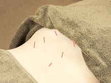 スマイル江古田鍼灸整体院/施術風景～鍼灸2～江古田鍼灸