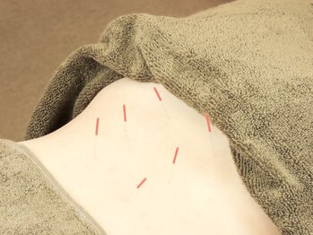 スマイル江古田鍼灸整体院/施術風景~鍼灸2~江古田鍼灸