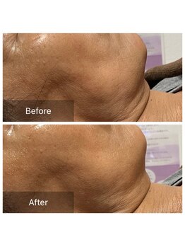 パピヨン(Papillon)/フェイスラインのたるみ改善◎