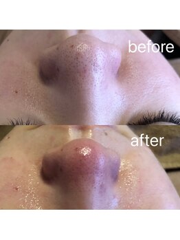 ナナラ(nanala)/毛穴洗浄