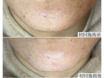 シエール 調布(Ci'aile)/本気の毛穴肌質改善