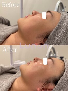 ルノン(Lunon)/毛穴洗浄ハイドロ×ララピール