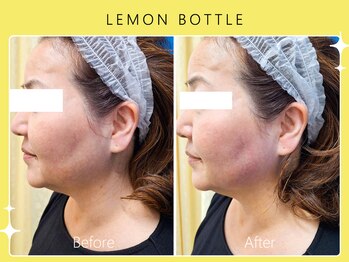 シロカネ 光の森店(SHIROKANE)/レモンボトル☆