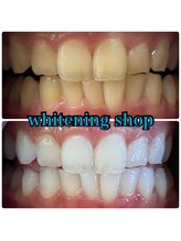ホワイトニングショップ 三ノ宮店/【お客様のビフォーアフター】