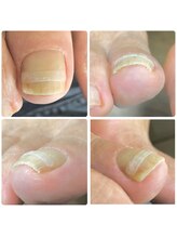 ネイル ウォッカ(NAiL VODKa)/【巻き爪ケア(B/S)】