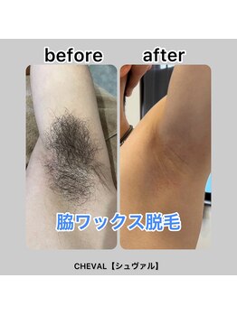 シュバル(CHEVAL)/脇ワックス脱毛